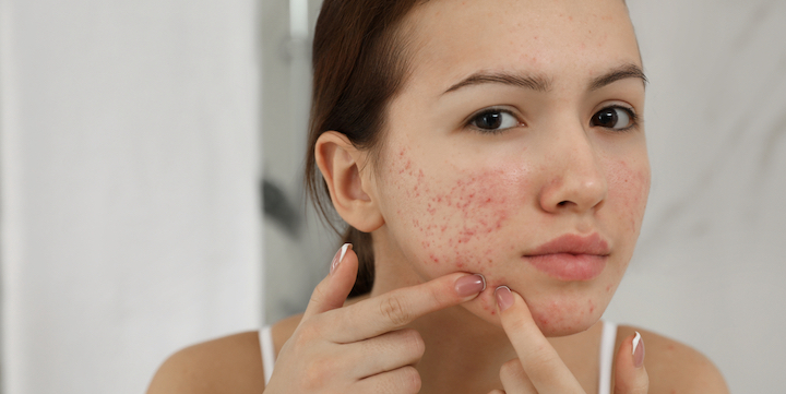 monitoring of patients on Roaccutane further strengthened