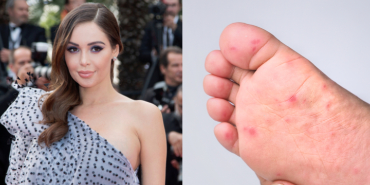 Nabilla has caught a madness: the hand-foot-mouth disease