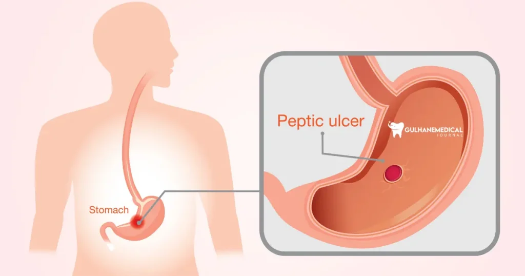 What are the effective factors in causing stomach ulcers?